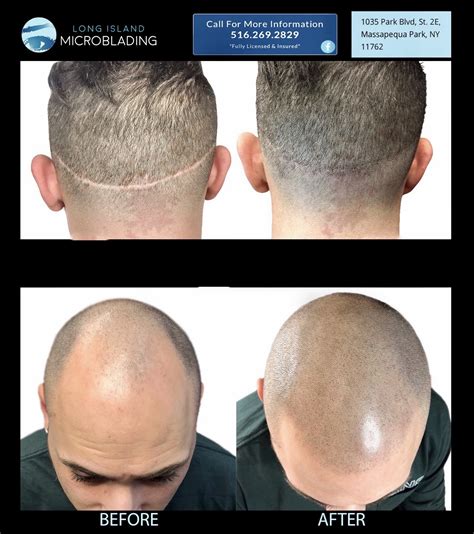 Scalp Micropigmentation in Worldwide • Check Prices & Reviews.